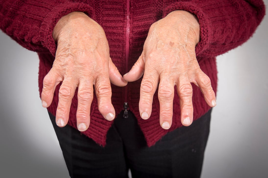 Hand Deformed From Rheumatoid Arthritis